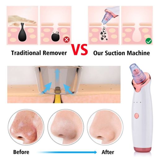 Blackhead Removing Vacuum Tool General Merchandise Health & Beauty